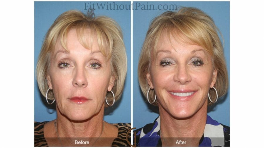 Facelift Without Surgery Review Did You Ever Want A Real Facelift?