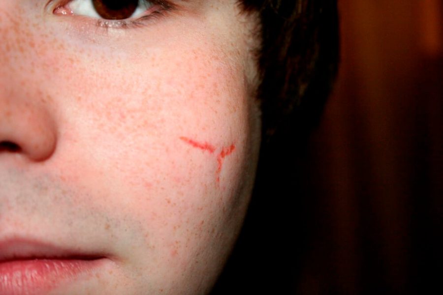 The Scar Solution Review How Quickly Can You Make Them Fade Away?